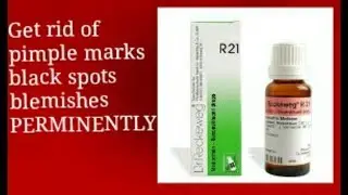 How to get rid of darks spots,blemishes,pimple marks PERMINENTLY
