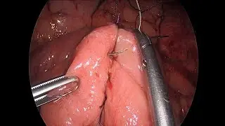 Emicolectomia sinistra e resezione ileale laparoscopiche per Malattia Diverticolare