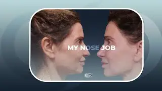 Beautiful Nose Reshaping Before and After | Dr. Stoker