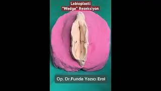 Labioplasti Ameliyatı “Wedge” Rezeksiyon Yöntemi #keşfet #keşfetbeniöneçıkar #keşfetteyiz