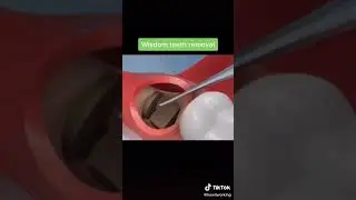 Зуб мудрости тик ток #tiktok #trend