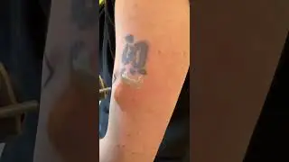 Tattoo Removal Treatment at Well Medical Arts in Seattle.