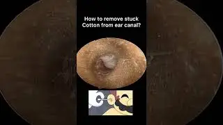 How to remove stuck cotton ball in ear?