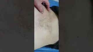 Лечение геморроя.