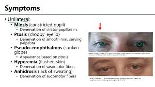 Horner's Syndrome LO4 - M1 Anatomy Learning Objectives