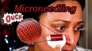 Microneedling with dermaroller Before and After 1 week results | PalsLivesLife