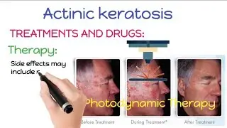 How To Treat and Remove Actinic Keratosis | Actinic Keratosis Treatment And Removal Procedures