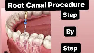 root canal procedure #teeth #viral #explorepage #foryou #dentistry