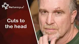 Cuts to the Head