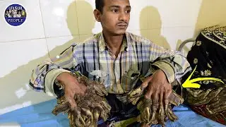 THE STRANGE SKIN OF THESE PEOPLE LOOKS LIKE BARK