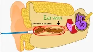 Putting Q-Tips In Your Ears Is VERY Bad For Your Health, And Here's Why