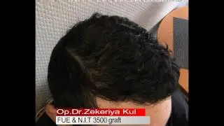 Dr.Zekeriya Kul-Haartransplantation 3500 Grafts