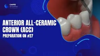Anterior All-Ceramic Crown (ACC) Preparation on #27 | Caapid Simplified Bench Prep Course