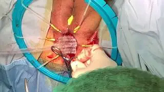 AndroMesh- male incontinence