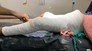 Hip Spica cast for femur fracture in a 3 year kid #thighbone #fracture #healing #pediatricortho