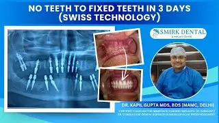 Strategic Dental Implants- A quick & reliable solution to replace missing teeth