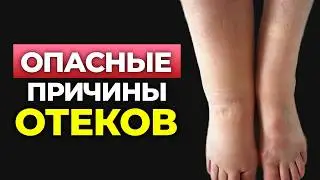 Как ИЗБАВИТЬСЯ ОТ ОТЁКОВ? Причины появления и проверенные методы лечения