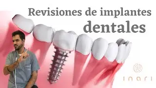 Revisiones de implantes dentales