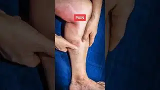 Preventing blood clots after orthopedic 