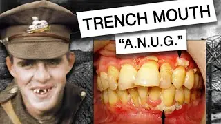 Acute Necrotizing Ulcerative Gingivitis AKA TRENCH MOUTH