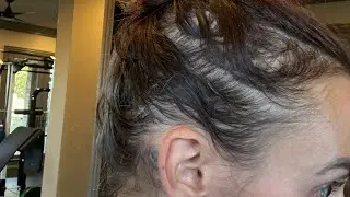 My Hair Loss Journey