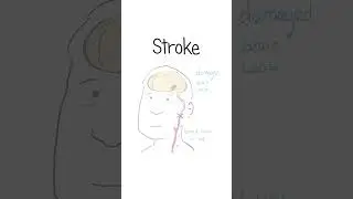 Strokes Explained #healthsketch #shorts