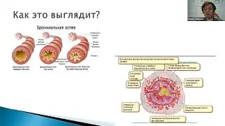 Лечение астмы. Людмила Ромбак
