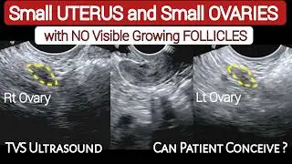 Small Uterus and Small Ovaries - with No Visible Growing Follicles - TVS Ultrasound