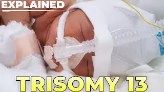 A Comprehensive Guide to Trisomy 13: Statistics, Medical, Parents & Children.