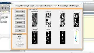 Fuzzy Clustering based Segmentation of Vertebrae in T1 Weighted Spinal MRI Images MATLAB Code