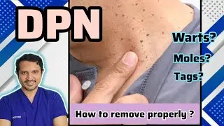 Clear your skin : Top solutions for treating DPN | Dr.Chiranjaya | 