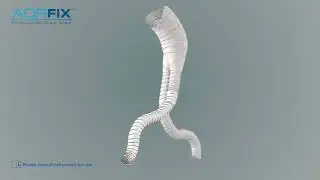 Aorfix - EVAR Animation - Operational Video
