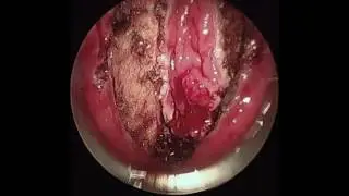 Transanal Endoscopic Microsurgery (TEM): Approach to Rectal Sleeve Resection