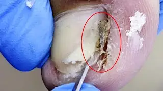 Pedicure Tutorial：Dirt hides under the ingrown【Pedicure Master Lin Jun】