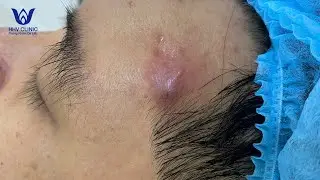 NẶN MỤN VIÊM TỤ CẦU - ÁP XE HIỆU QUẢ SAU 1 BUỔI, CAM KẾT KHÔNG ĐỂ LẠI SẸO TẠI PK DA LIỄU HHV CLINIC.