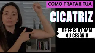 Como TRATAR a tua CICATRIZ de EPISIOTOMIA ou CESÁRIA