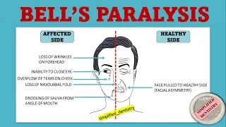 Bell's Palsy: A Deep Dive for First-Year BDS Students