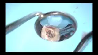 #14 Onlay Prep  under Zeiss Extaro Microscope