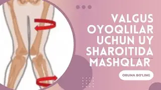 Valgus oyoqlilar ( X obrazna) uy sharoitida mashqlar! 