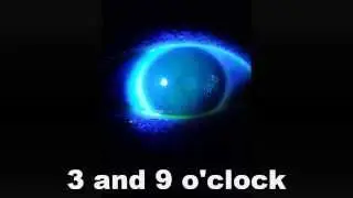 Analyzing Rigid Contact Lens Staining Patterns