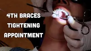 Come with me to my adult braces tightening appointment - raw real - does it hurt after?