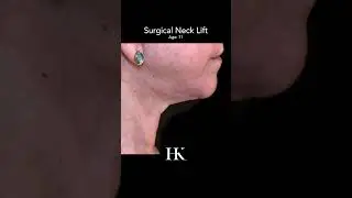 Surgical Neck Lift Before and After performed by Dr. Khorasani | NYC Surgeon