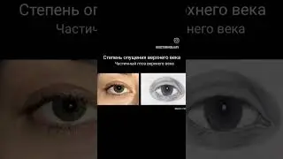 Что такое птоз верхнего века?