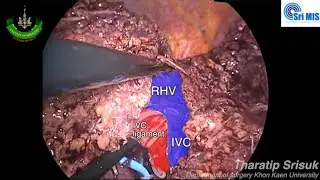 Laparoscopic right hepatectomy (Educational nearly uncut)