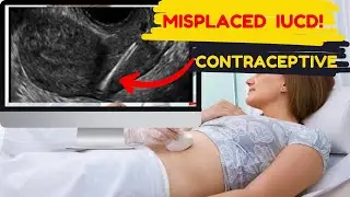 Ultrasound showing Misplaced Intrauterine Contraceptive Device | IUCD