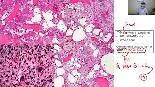 BONE PATHOLOGY: BONE TUMORS