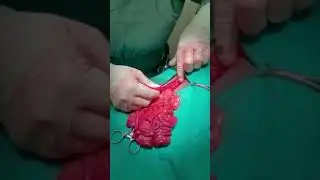 Foreign body removal from bowel