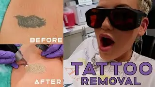 Laser Tattoo Removal Vlog #1