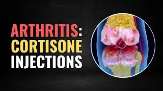 Why Cortisone Shots for Knee Arthritis Might Be Wrong For You