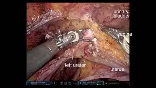 Robotic posterior pelvic exenteration for huge rectal gastrointestinal stromal tumor